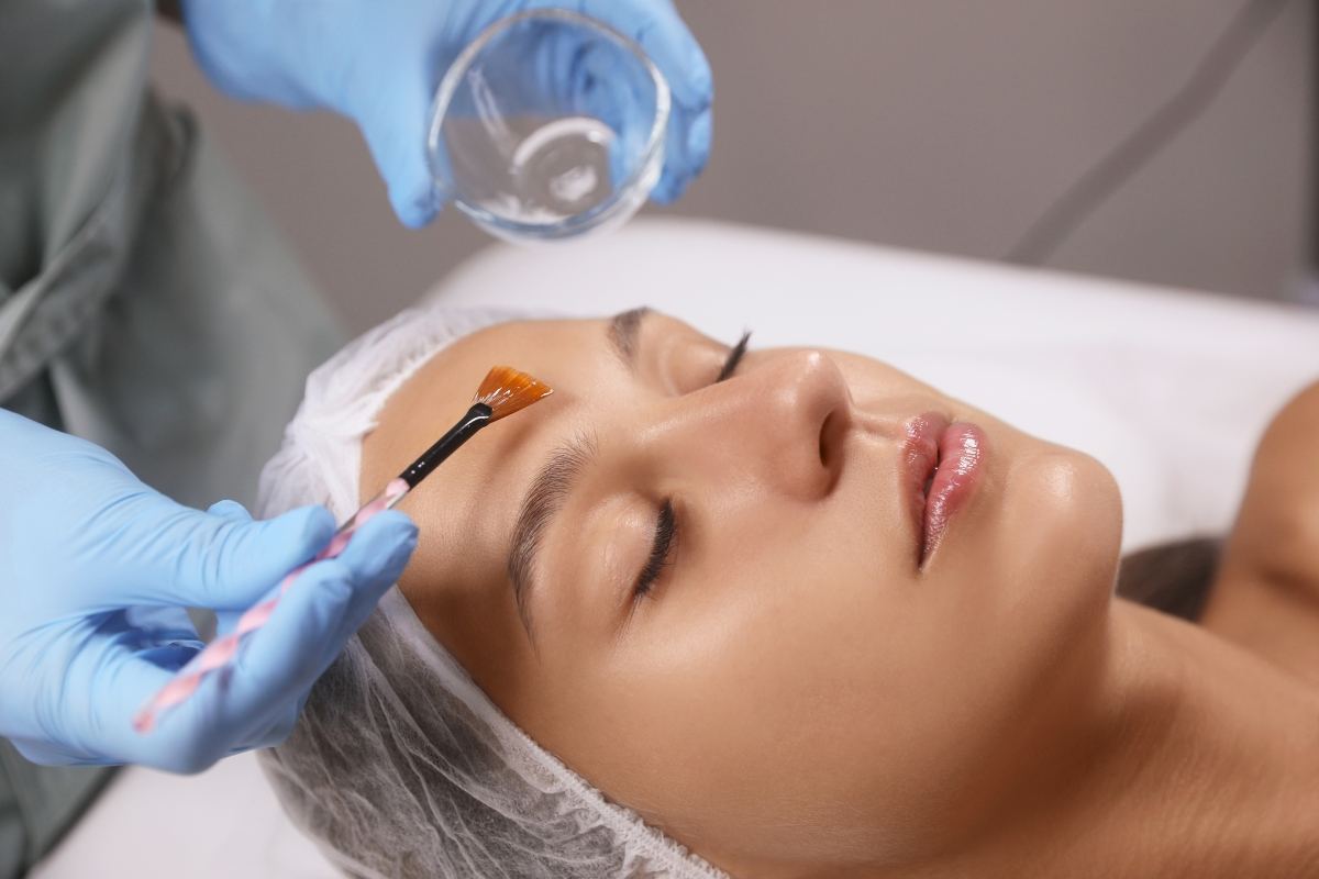 Chemical Peels